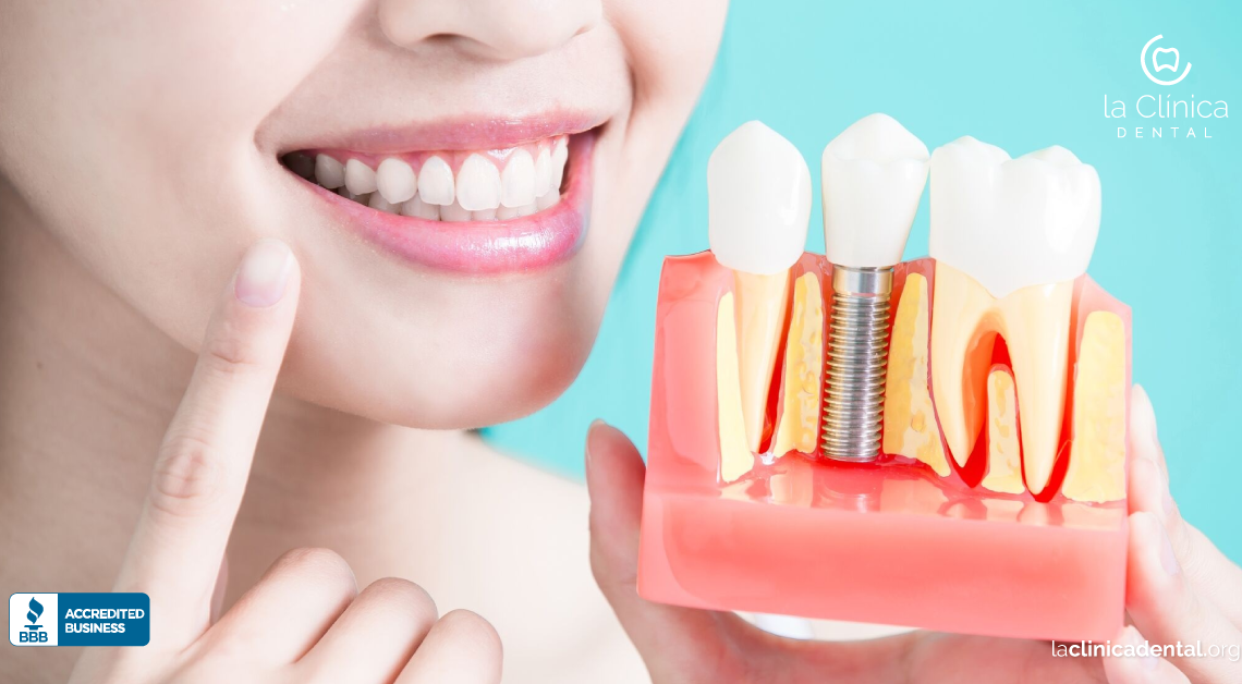 Implantes Dentales
